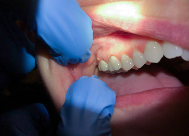 Best Emergency Dental Care for Abscessed Tooth in Gibraltar, MI
